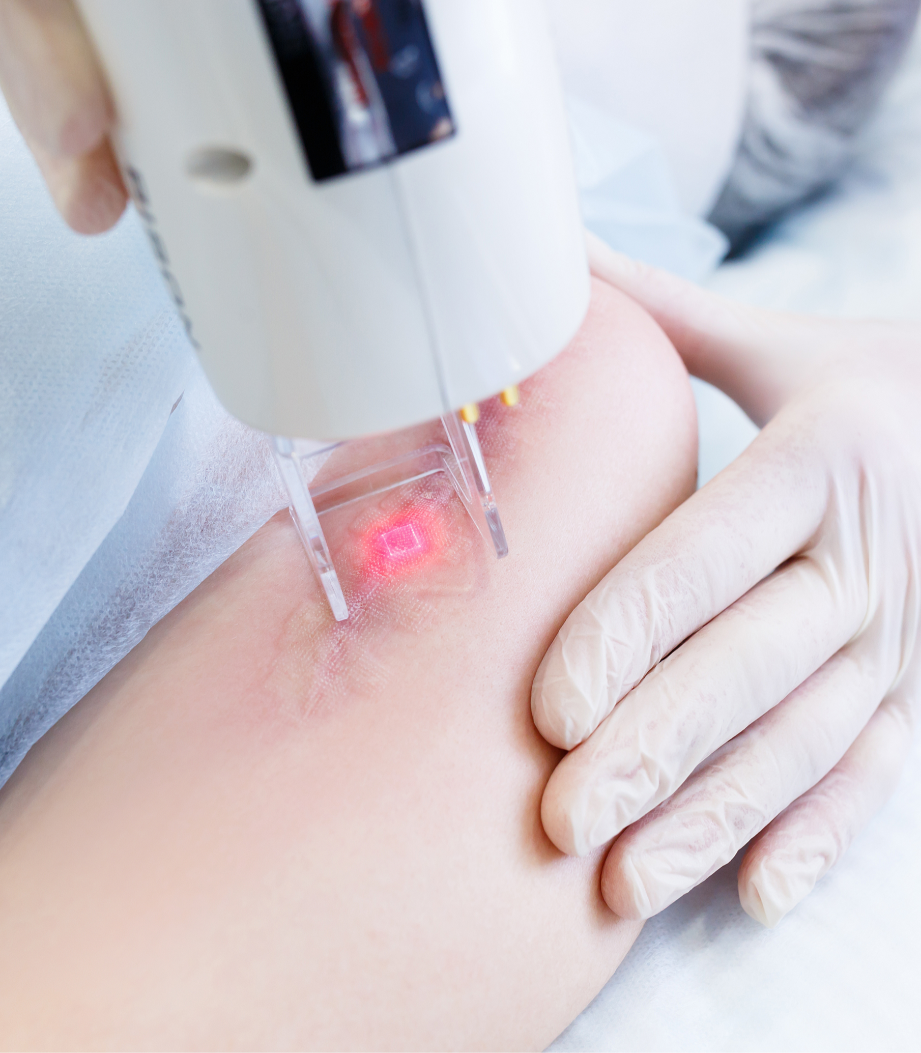 Chirurgia estetica e trattamento laser su cicatrice ipertrofica